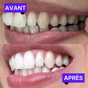 14 Bandes Blanchissantes