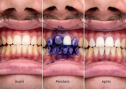 Dentifrice Violet Blanchisseur